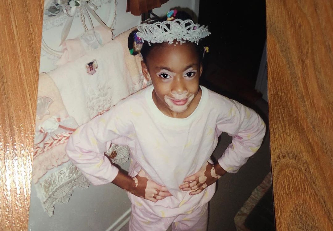 Winnie Harlow