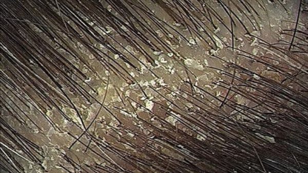 Scalp build Up