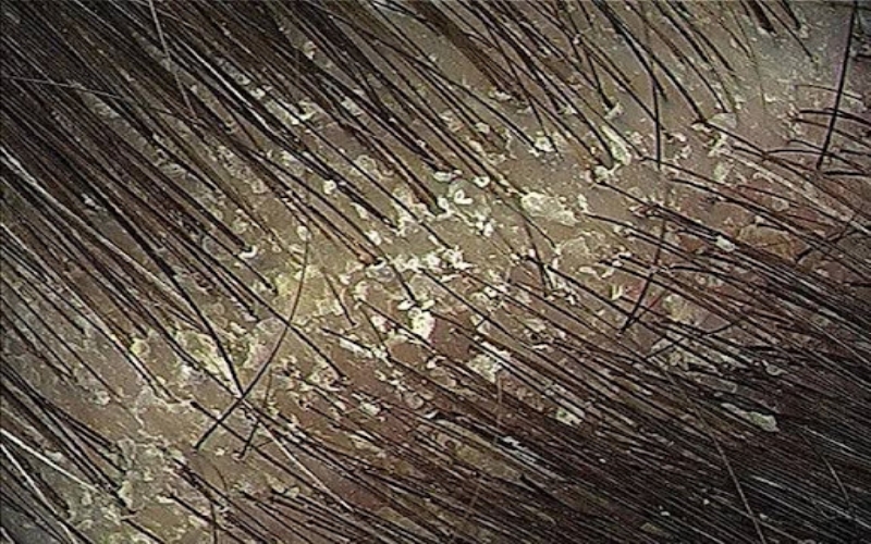 Scalp build Up